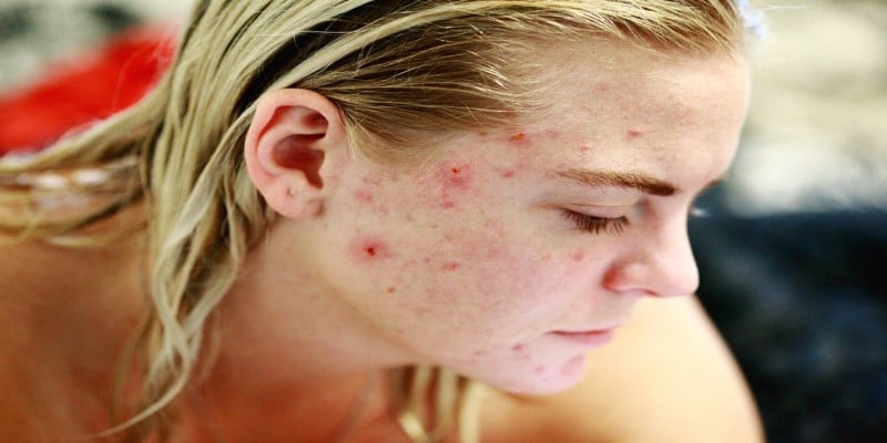 CBD Akne Hautkrankheiten